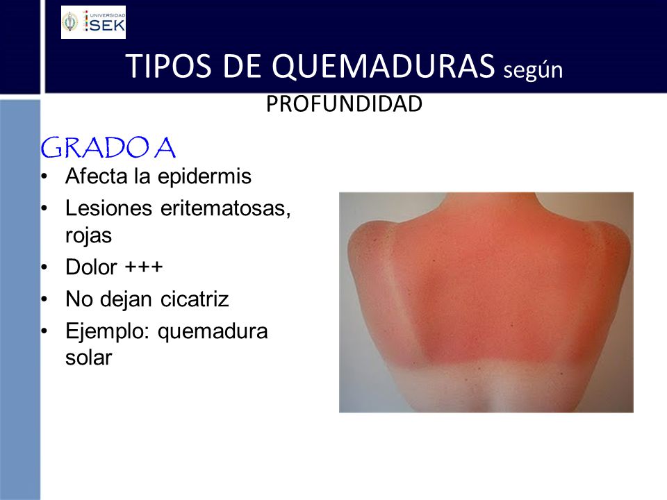 clases de quemaduras por el sol